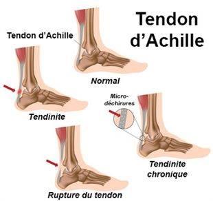 Pathologies du tendon d’Achille et étiopathie